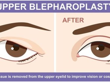 Upper Blepharoplasty in Thailand